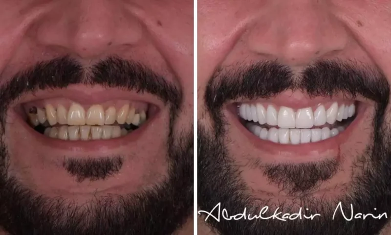 gulus-tasarimi-before-after-1024x614.jpg Health Procedures